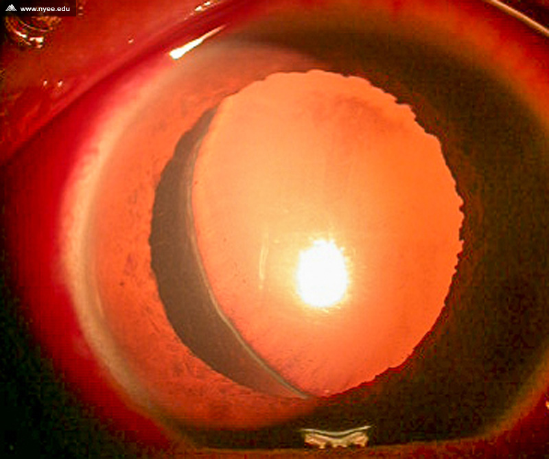 Dislocated Cristallin Lens Posterior (2 of 3) NYEE